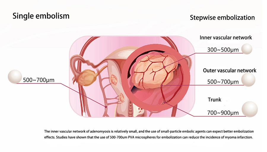 Embosphere Microspheres Used in Uterine Artery Embolization: A Breakthrough in ...